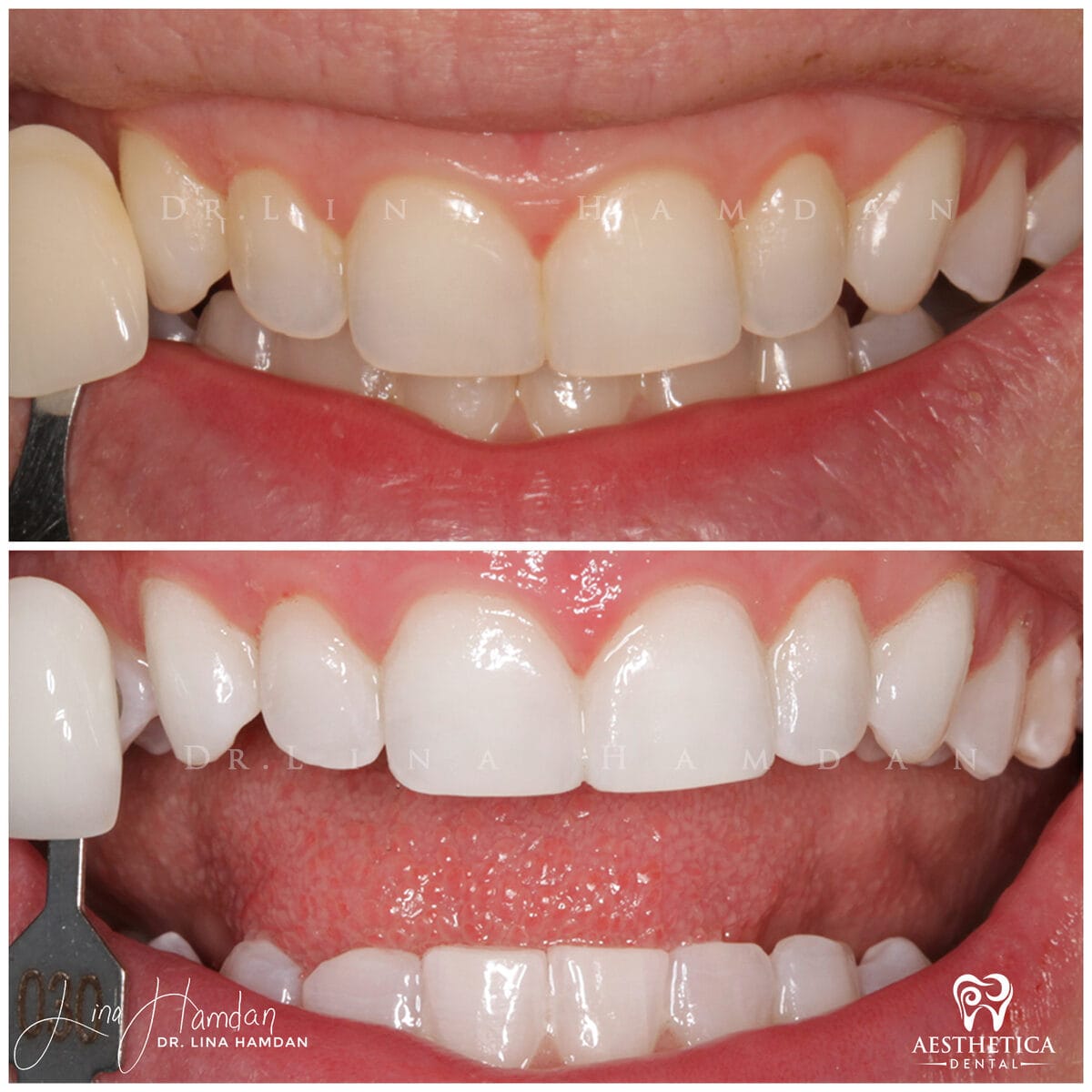 Teeth whitening: anonymous case 20 from Aesthetica Dental Naperville