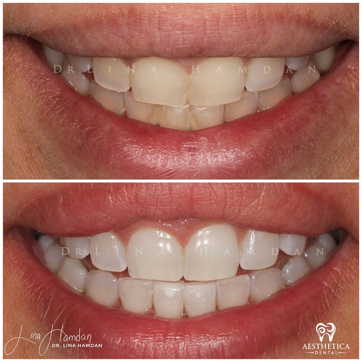 Teeth whitening: anonymous case 21 from Aesthetica Dental Naperville