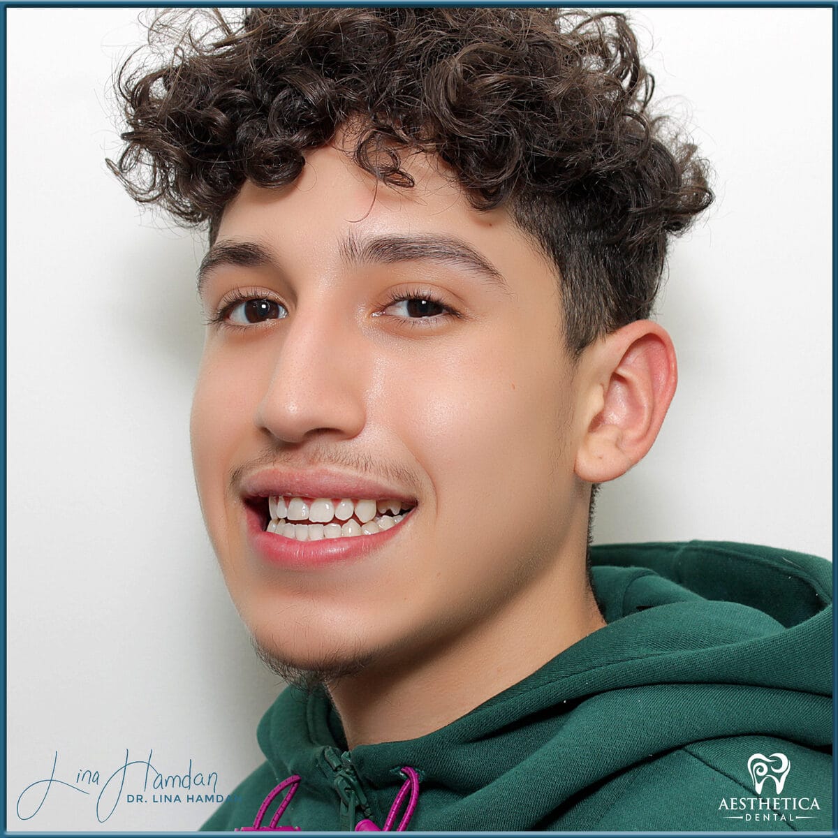 Teeth whitening case 11, anonymous patient at Aesthetica Dental Naperville, photo 1