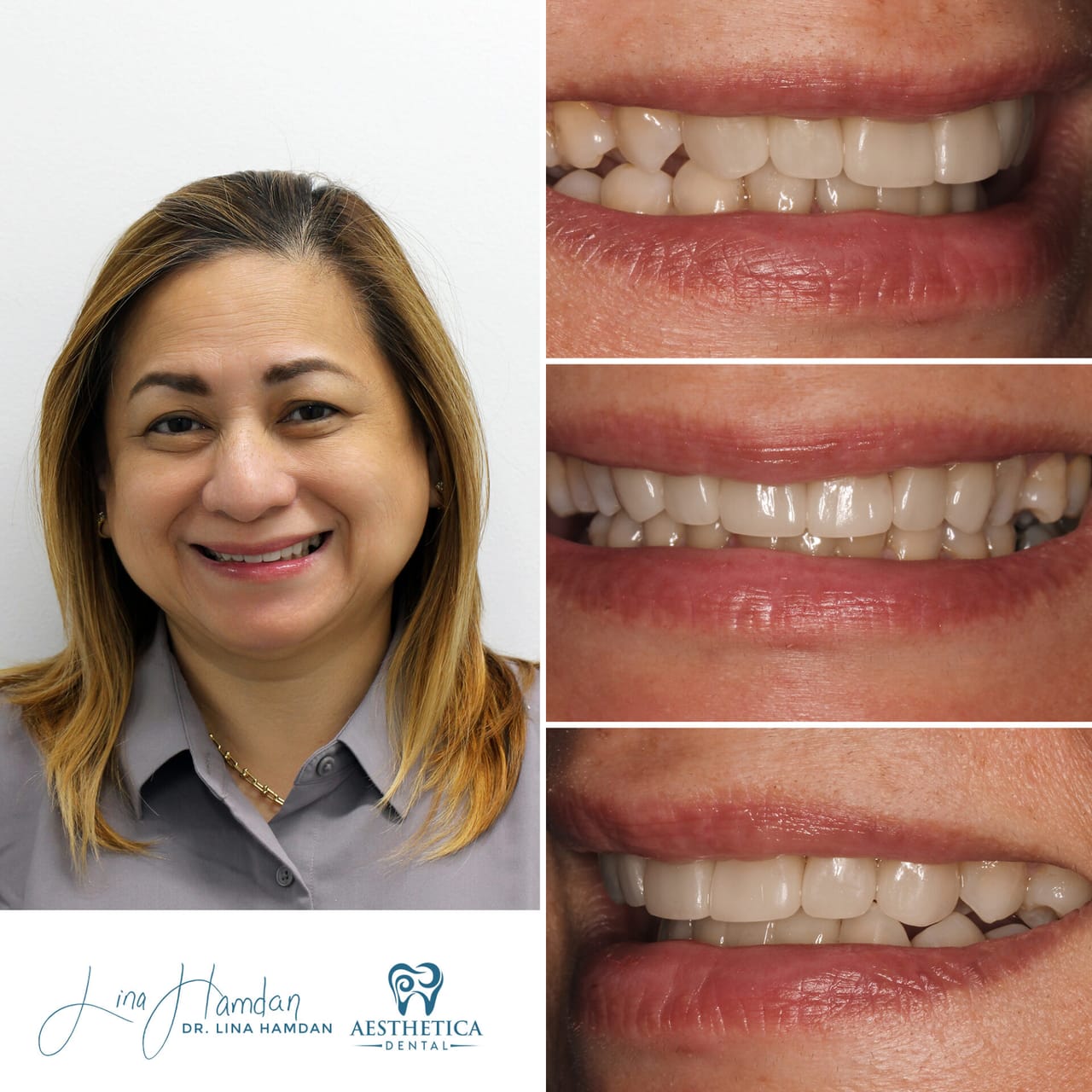 Veneers: patient result by Dr. Lina Hamdan